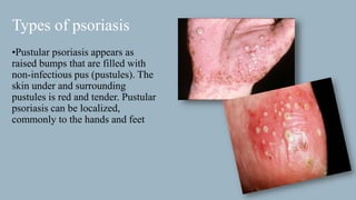 dermatology - Psoriasis | PPTX