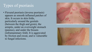 dermatology-psoriasis-ppt