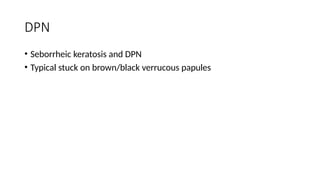 DPN
• Seborrheic keratosis and DPN
• Typical stuck on brown/black verrucous papules
 
