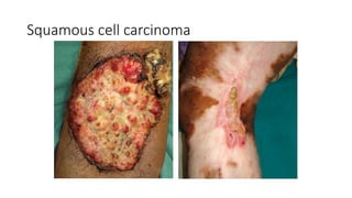 Squamous cell carcinoma
 