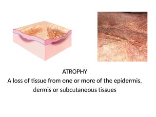 Comprehensive Overview of Dermatological Lesions and Diseases | PPTX