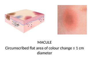 Macule Example Comprehensive Overview of Dermatological Lesions and Diseases | PPTX