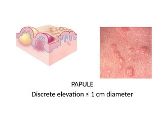 Comprehensive Overview of Dermatological Lesions and Diseases | PPTX