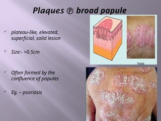Apd Rashes ATOPIC DERMATITIS (AD) AD is an itchy, chronic, or chronically ...
