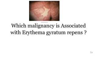 Which malignancy is Associated
with Erythema gyratum repens ?
5a
 