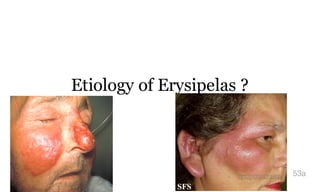 Etiology of Erysipelas ?
53a
 