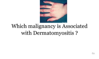 Which malignancy is Associated
with Dermatomyositis ?
6a
 