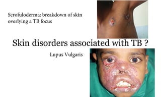 Skin disorders associated with TB ?
65a
Lupus Vulgaris
Scrofuloderma: breakdown of skin
overlying a TB focus
 