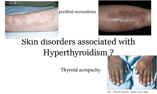Skin disorders associated with
Hyperthyroidism ?
67a
pretibial myxoedema
Thyroid acropachy
 