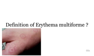 Definition of Erythema multiforme ?
68a
 