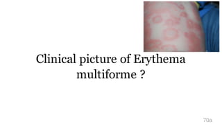 Clinical picture of Erythema
multiforme ?
70a
 