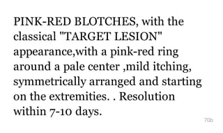 PINK-RED BLOTCHES, with the
classical "TARGET LESION"
appearance,with a pink-red ring
around a pale center ,mild itching,
symmetrically arranged and starting
on the extremities. . Resolution
within 7-10 days.
70b
 