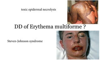 DD of Erythema multiforme ?
71a
Steven-Johnson syndrome
toxic epidermal necrolysis
 