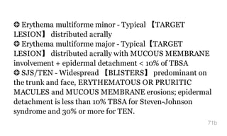 ❂ Erythema multiforme minor - Typical 【TARGET
LESION】 distributed acrally
❂ Erythema multiforme major - Typical【TARGET
LESION】 distributed acrally with MUCOUS MEMBRANE
involvement + epidermal detachment < 10% of TBSA
❂ SJS/TEN - Widespread 【BLISTERS】 predominant on
the trunk and face, ERYTHEMATOUS OR PRURITIC
MACULES and MUCOUS MEMBRANE erosions; epidermal
detachment is less than 10% TBSA for Steven-Johnson
syndrome and 30% or more for TEN.
71b
 