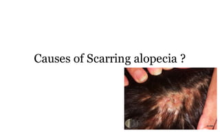 Causes of Scarring alopecia ?
73a
 