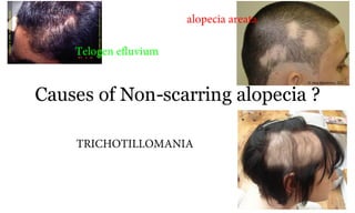 Causes of Non-scarring alopecia ?
74a
TRICHOTILLOMANIA
alopecia areata
Telogen efluvium
 