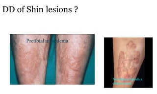 DD of Shin lesions ?
78a
Necrobiosis lipoidica
diabeticorum
Pretibial myxedema
 