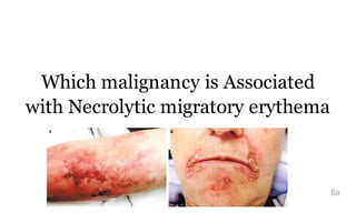 Which malignancy is Associated
with Necrolytic migratory erythema
?
8a
 