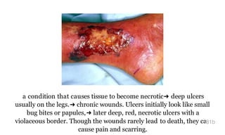a condition that causes tissue to become necrotic➜ deep ulcers
usually on the legs.➜ chronic wounds. Ulcers initially look like small
bug bites or papules,➜ later deep, red, necrotic ulcers with a
violaceous border. Though the wounds rarely lead to death, they can
cause pain and scarring.
81b
 