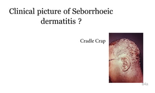 Clinical picture of Seborrhoeic
dermatitis ?
84a
Cradle Crap
 