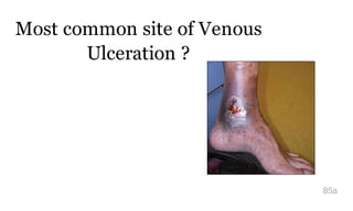 Most common site of Venous
Ulceration ?
85a
 