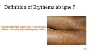 Definition of Erythema ab igne ?
89a
reticular pigmented rashon shins + slow relaxing
reflexes → Hypothyroidism (sitting near the fire)
 