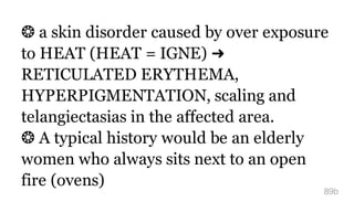 ❂ a skin disorder caused by over exposure
to HEAT (HEAT = IGNE) ➜
RETICULATED ERYTHEMA,
HYPERPIGMENTATION, scaling and
telangiectasias in the affected area.
❂ A typical history would be an elderly
women who always sits next to an open
fire (ovens)
89b
 