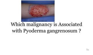 Which malignancy is Associated
with Pyoderma gangrenosum ?
9a
 