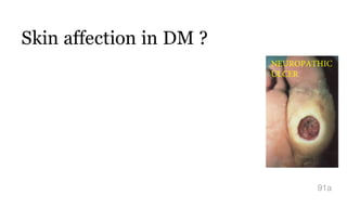 Skin affection in DM ?
91a
NEUROPATHIC
ULCER
 