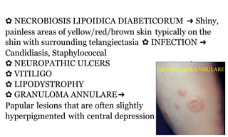 ✿ NECROBIOSIS LIPOIDICA DIABETICORUM ➜ Shiny,
painless areas of yellow/red/brown skin typically on the
shin with surrounding telangiectasia ✿ INFECTION ➜
Candidiasis, Staphylococcal
✿ NEUROPATHIC ULCERS
✿ VITILIGO
✿ LIPODYSTROPHY
✿ GRANULOMA ANNULARE➜
Papular lesions that are often slightly
hyperpigmented with central depression
91b
GRANULOMA ANNULARE
 