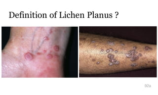 Definition of Lichen Planus ?
92a
 