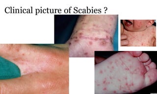 Clinical picture of Scabies ?
97a
 