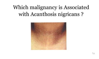 Which malignancy is Associated
with Acanthosis nigricans ?
1a
Dr. Sherif
Badrawy
Digitally signed by Dr. Sherif
Badrawy
DN: cn=Dr. Sherif Badrawy,
o=KKUH, ou=Critical Care,
email=sherif_badrawy@yahoo.c
om, c=SA
Date: 2015.05.29 03:20:36
+03'00'
 