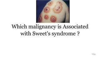 Which malignancy is Associated
with Sweet's syndrome ?
10a
 