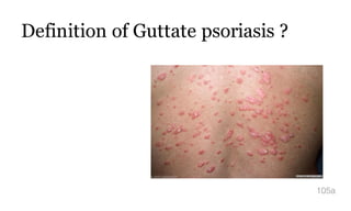 Definition of Guttate psoriasis ?
105a
 