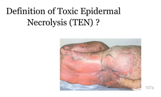 Definition of Toxic Epidermal
Necrolysis (TEN) ?
107a
 