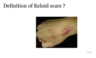 Definition of Keloid scars ?
110a
 