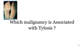 Which malignancy is Associated
with Tylosis ?
11a
 