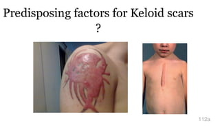 Predisposing factors for Keloid scars
?
112a
 
