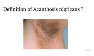 Definition of Acanthosis nigricans ?
114a
 