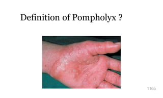Definition of Pompholyx ?
116a
 