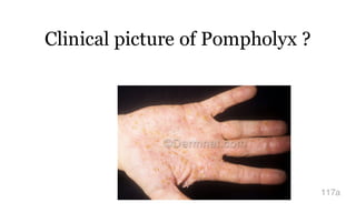 Clinical picture of Pompholyx ?
117a
 
