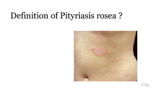 Definition of Pityriasis rosea ?
119a
 