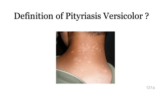 Definition of Pityriasis Versicolor ?
121a
 