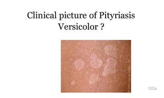 Clinical picture of Pityriasis
Versicolor ?
122a
 