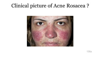 Clinical picture of Acne Rosacea ?
126a
 