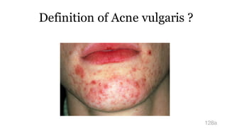 Definition of Acne vulgaris ?
128a
 