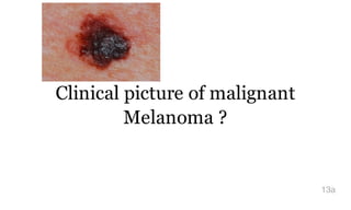 Clinical picture of malignant
Melanoma ?
13a
 