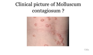 Clinical picture of Molluscum
contagiosum ?
138a
 