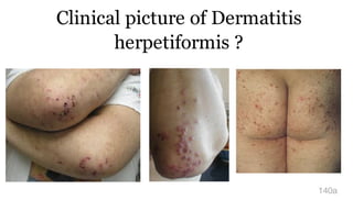 Clinical picture of Dermatitis
herpetiformis ?
140a
 